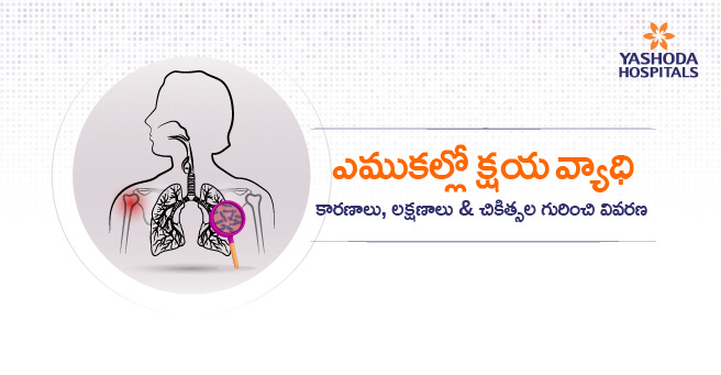 bone tuberculosis main banner