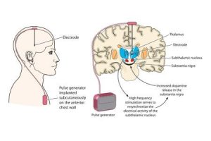 Parkinson’s disease treatment