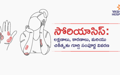 సోరియాసిస్: లక్షణాలు, కారణాలు, మరియు చికిత్సను గూర్చి సంపూర్ణ వివరణ