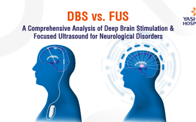 DBS vs. FUS: A Comprehensive Analysis of Deep Brain Stimulation & Focused Ultrasound for Neurological Disorders