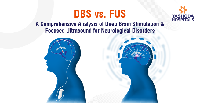 DBS vs. Focused Ultrasound_Main