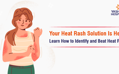 Your Heat Rash Solution Is Here: Learn How to Identify and Beat Heat Rash