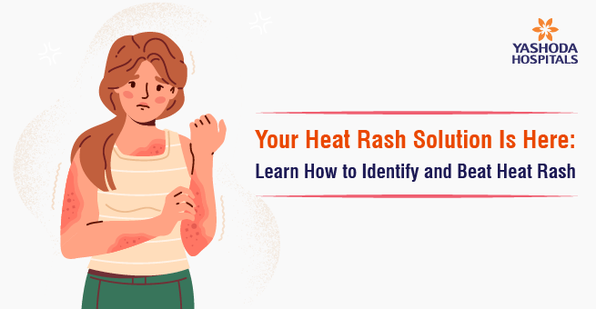 Your Heat Rash Solution Is Here: Learn How to Identify and Beat Heat Rash