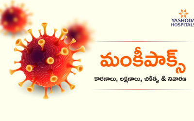 Mpox (మంకీపాక్స్): కారణాలు, లక్షణాలు, చికిత్స & నివారణ