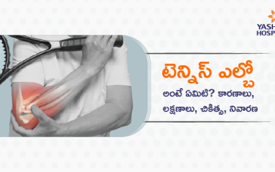 టెన్నిస్ ఎల్బో అంటే ఏమిటి? కారణాలు, లక్షణాలు, చికిత్స, నివారణ