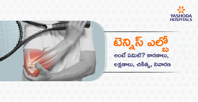 టెన్నిస్ ఎల్బో అంటే ఏమిటి? కారణాలు, లక్షణాలు, చికిత్స, నివారణ