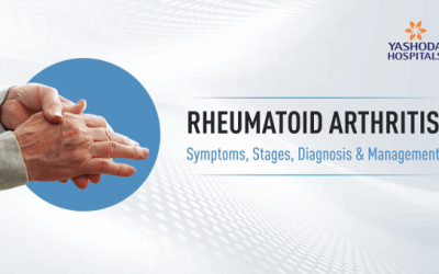 Rheumatoid Arthritis Explained: Symptoms, Stages, Diagnosis & Management