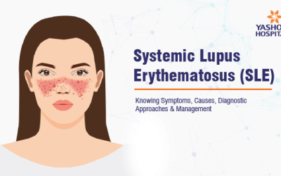 Systemic Lupus Erythematosus (SLE): Knowing Symptoms, Causes, Diagnostic Approaches & Management