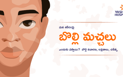 మన శరీరంపై బొల్లి మచ్చలు ఎందుకు వస్తాయి? బొల్లి నివారణ, లక్షణాలు, చికిత్స