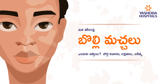 మన శరీరంపై బొల్లి మచ్చలు ఎందుకు వస్తాయి? బొల్లి నివారణ, లక్షణాలు, చికిత్స