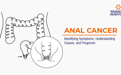 Anal Cancer: Identifying Symptoms, Understanding Causes, and Prognosis