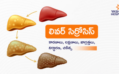 లివర్ సిర్రోసిస్ : కారణాలు, లక్షణాలు, జాగ్రత్తలు, నిర్ధారణ, చికిత్స