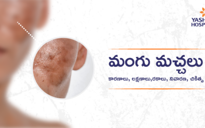 మంగు మచ్చలు (పిగ్మెంటేషన్) : కారణాలు, లక్షణాలు,రకాలు, నివారణ, చికిత్స