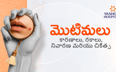మొటిమలు: కారణాలు, రకాలు, నివారణ మరియు చికిత్స