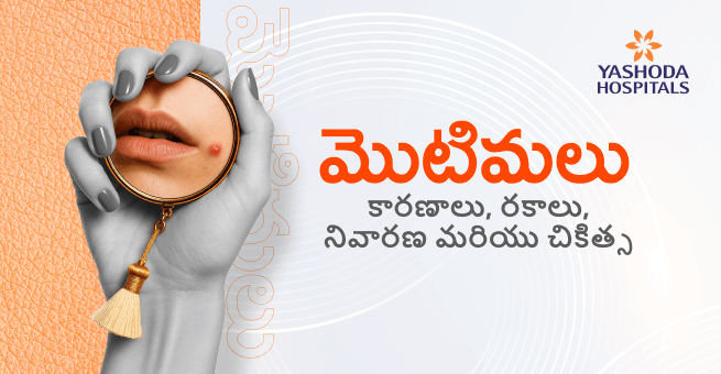 మొటిమలు: కారణాలు, రకాలు, నివారణ మరియు చికిత్స