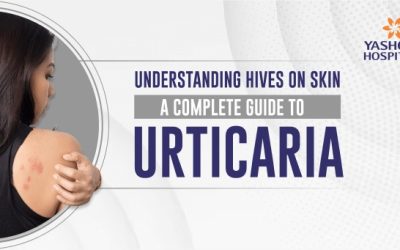 Understanding Hives on Skin: A Complete Guide to Urticaria