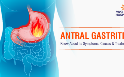 Antral Gastritis: Know About its Symptoms, Causes & Treatment