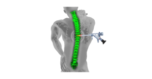 endoscopic-spine-surgery