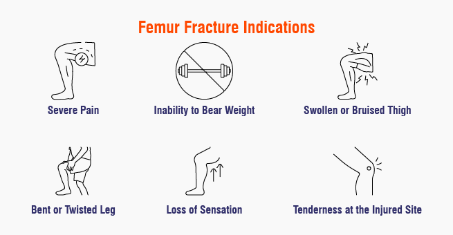 Femur Fractures_Body 1