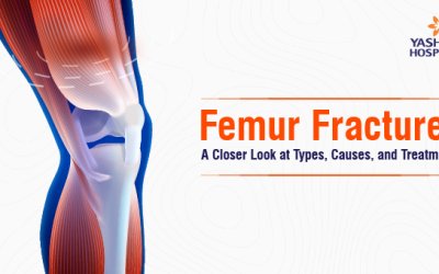 Femur Fractures: A Closer Look at Types, Causes, and Treatments