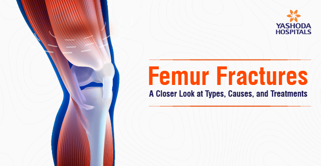 Femur Fractures_Main