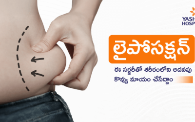 లైపోసక్షన్ : ఈ సర్జరీతో శరీరంలోని అదనపు కొవ్వు మాయం చేసేద్దాం