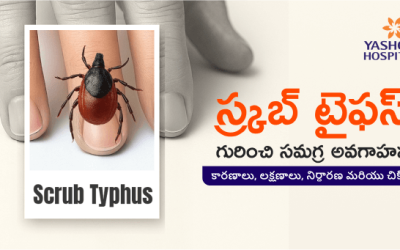 స్క్రబ్ టైఫస్ గురించి సమగ్ర అవగాహన – కారణాలు, లక్షణాలు, నిర్ధారణ మరియు చికిత్స