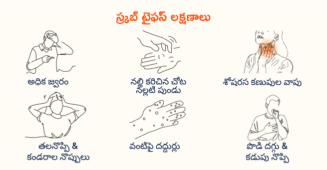 Scrub typhus Symptoms