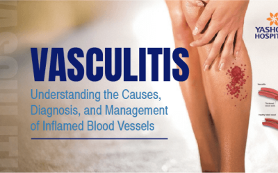 Vasculitis: Understanding the Causes, Diagnosis, and Management of Inflamed Blood Vessels