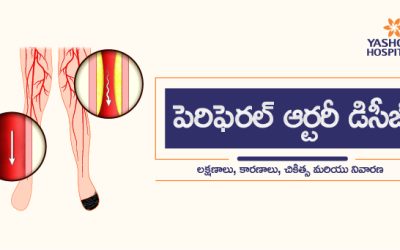 పెరిఫెరల్ ఆర్టరీ డిసీజ్ (PAD): లక్షణాలు, కారణాలు, చికిత్స మరియు నివారణ