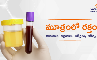 మూత్రంలో రక్తం (హెమటూరియా): కారణాలు, లక్షణాలు పరీక్షలు, చికిత్స