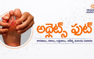 అథ్లెట్స్ ఫుట్ : కారణాలు, రకాలు, లక్షణాలు, చికిత్స మరియు నివారణ