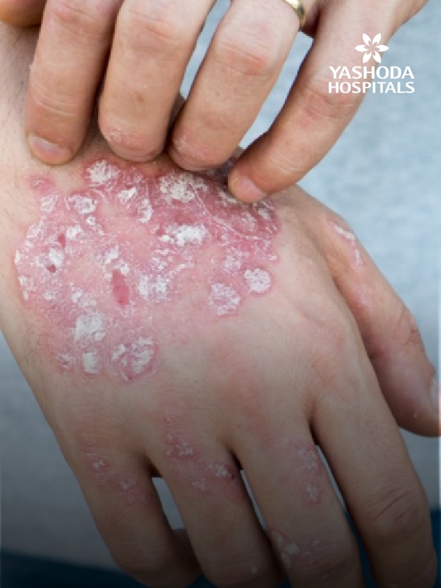 Autoimmune Condition banner