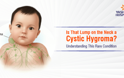 Is That Lump on the Neck a Cystic Hygroma? Understanding This Rare Condition