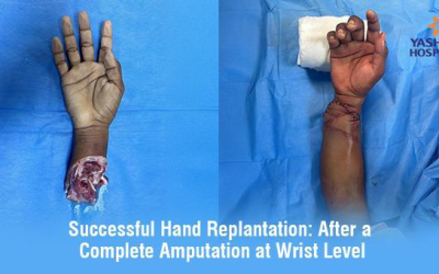 Successful Hand Replantation: After a Complete Amputation at Wrist Level