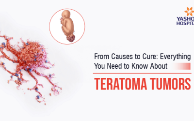 From Causes to Cure: Everything You Need to Know About Teratoma Tumors