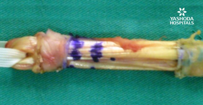 Hamstring Tendon Autograft