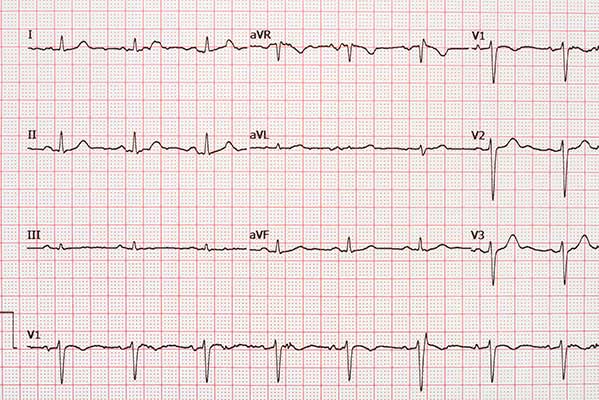 AV nodal re-entrant tachycardia