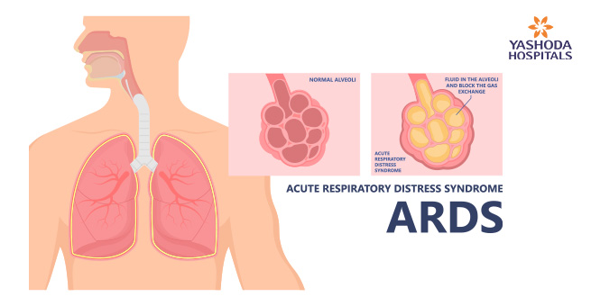 Acute Respiratory Distress Syndrome