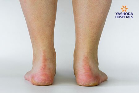 Adult Acquired Flatfoot: what are the Symptoms, Risk Factors, and Complications?