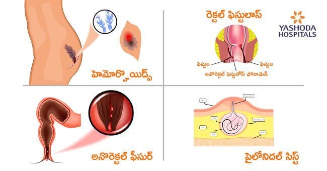 Anorectal Diseases