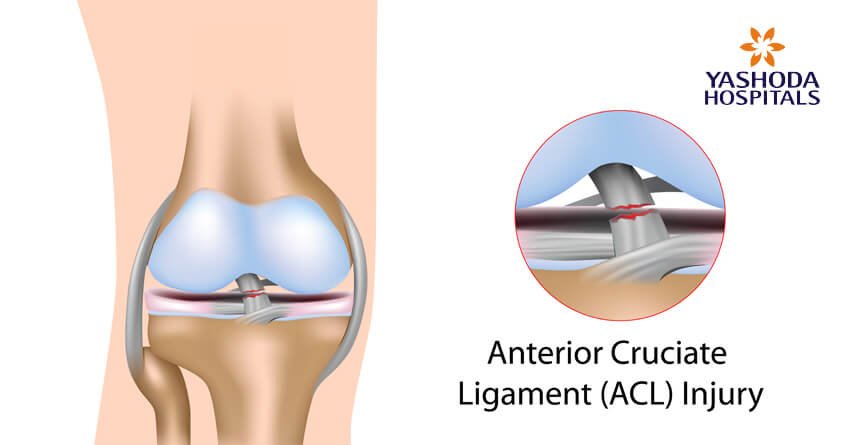 Anterior Cruciate Ligament (ACL) injury