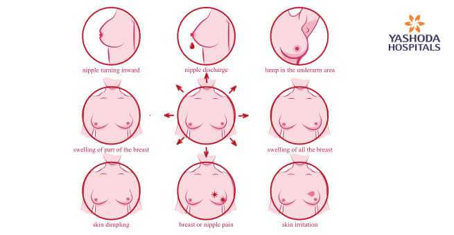 Symptoms of breast cancer