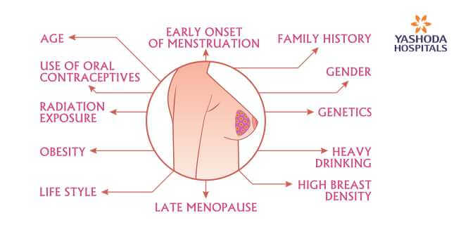 Breast cancer risk factors