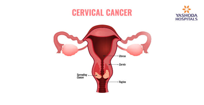 Cervical Cancer Cervical Cancer