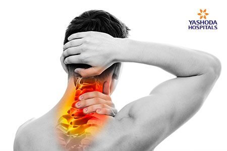 Cervical Spondylosis Causes