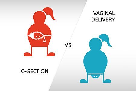 Cesarean delivery Vs Normal Delivery