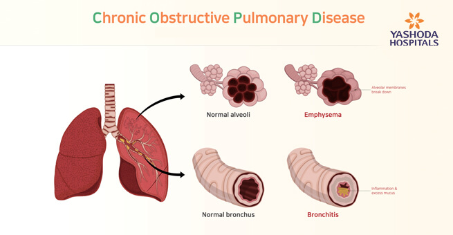 Chronic obstructive pulmonary disease