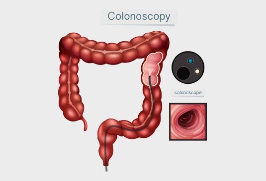 Colonoscopy Cost in India | Colonoscopy Cost in Hyderabad