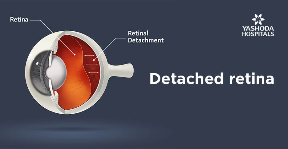 Detached Retina